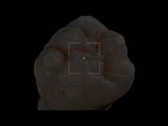 Full   contour   Zirconia 