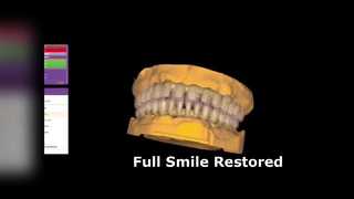 Removable Acrylic Dentures Restore Your Smile