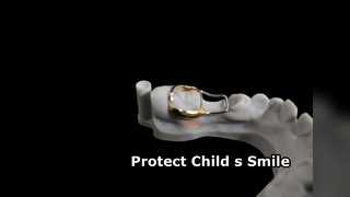 Pediatric Dental Space Maintainers Tooth Alignment