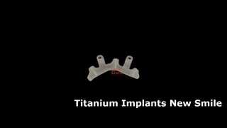 Titanium Dental Implants Restore Smiles
